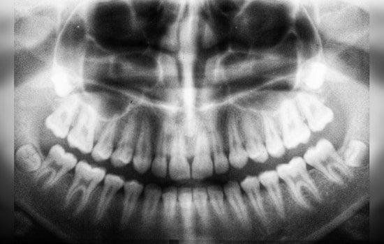 Tufts University and American Academy of Oral and Maxillofacial Radiology Declare Lead Aprons Obsolete for Dental X-rays