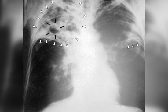 UMass Boston Confirms Active Tuberculosis Case with 39 Contacts Identified, No Significant Risk to Broader Community