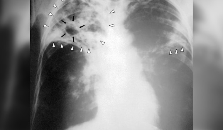 UMass Boston Confirms Active Tuberculosis Case with 39 Contacts Identified, No Significant Risk to Broader Community