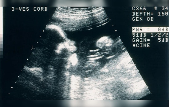 IVF Pioneer Dr. Merle Berger Sued for Allegedly Fathering Patient's Daughter in '80s Sperm Swap Scandal