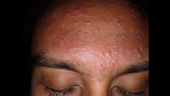 Zit's Incredible! UC San Diego Scientists Engineer Groundbreaking Acne Vaccine