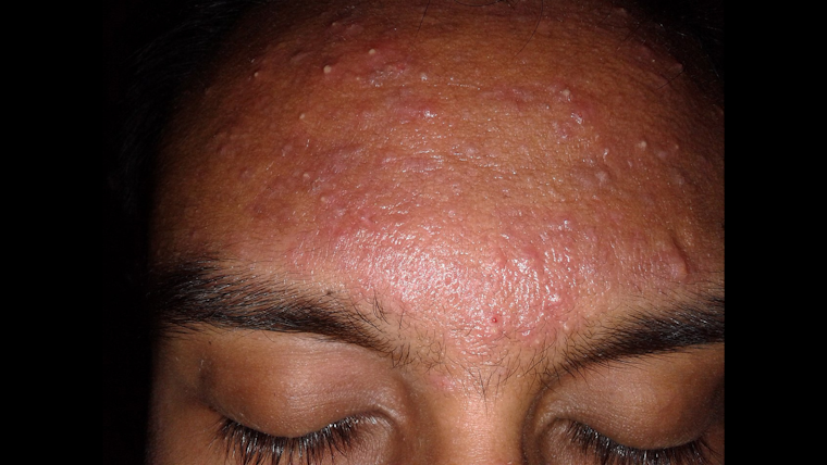 Zit's Incredible! UC San Diego Scientists Engineer Groundbreaking Acne Vaccine