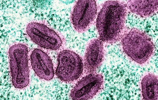 El Paso Health Officials Confirm Two Cases of Mpox, Urge Preventive Measures Amid Contact Tracing Efforts