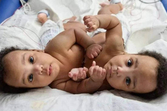 Philadelphia Surgeons at CHOP Celebrate Successful Separation of Conjoined Twins in Milestone Operation