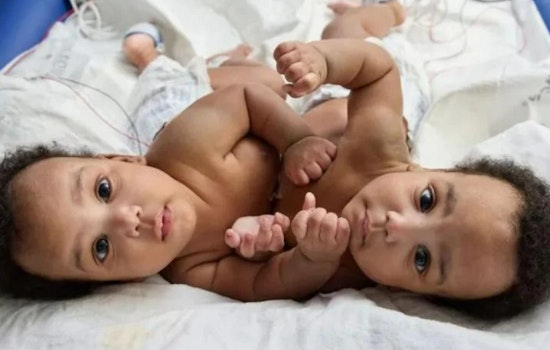 Philadelphia Surgeons at CHOP Celebrate Successful Separation of Conjoined Twins in Milestone Operation