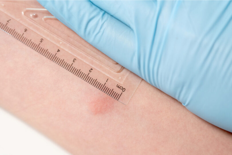 San Diego County Alerts Churchgoers of Potential TB Exposure in La Jolla