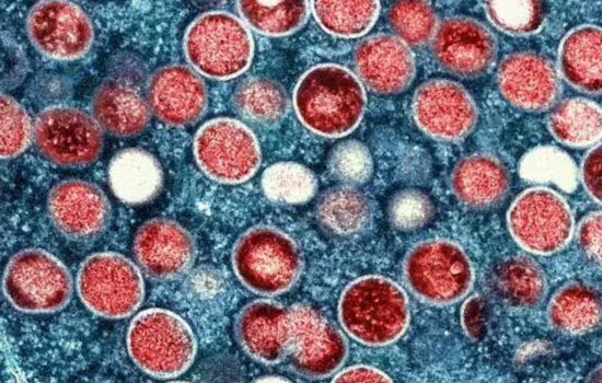 New Mpox Strain Detected in San Mateo County, California, Health Officials Monitor Without Alarm