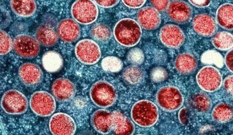 New Mpox Strain Detected in San Mateo County, California, Health Officials Monitor Without Alarm