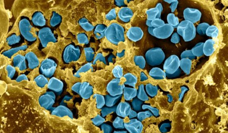 Boulder County Resident Diagnosed with Rare Pneumonic Tularemia, Public Health Officials Issue Warning