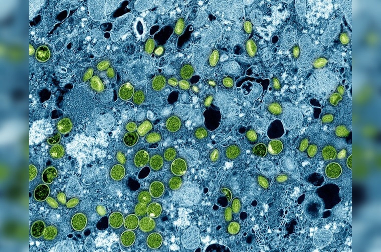 First U.S. Case of New mpox Strain Identified in Northern California, Public Risk Considered Low