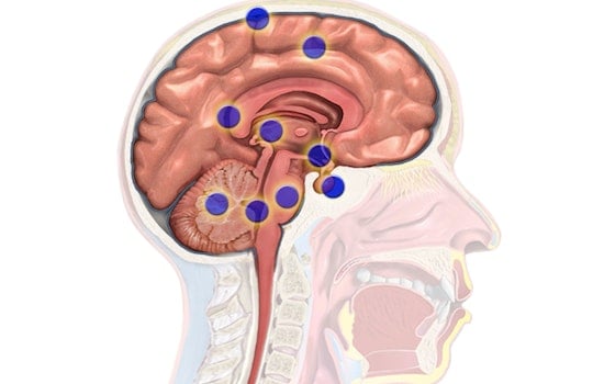 Harvard Study Unveils How Brain Cancers Like Gliomas Recur by Hijacking Neural Networks
