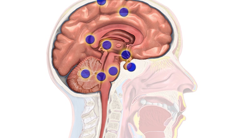 Harvard Study Unveils How Brain Cancers Like Gliomas Recur by Hijacking Neural Networks