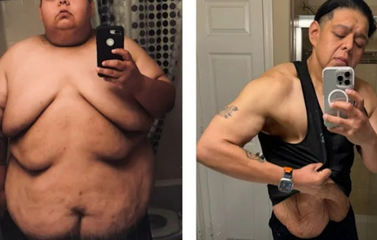 Glendale Man Triumphs Over Obesity and Sparks Inspiration, Crowdfunds for Life-Changing Skin Removal Surgery