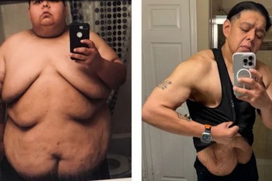 Glendale Man Triumphs Over Obesity and Sparks Inspiration, Crowdfunds for Life-Changing Skin Removal Surgery