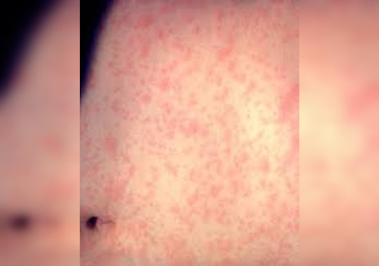 Los Angeles on Alert, Measles Case Confirmed with Exposure at LAX and Northridge Chick-Fil-A