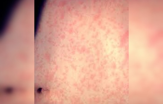 Los Angeles on Alert, Measles Case Confirmed with Exposure at LAX and Northridge Chick-Fil-A