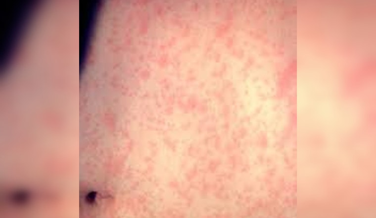 Los Angeles on Alert, Measles Case Confirmed with Exposure at LAX and Northridge Chick-Fil-A