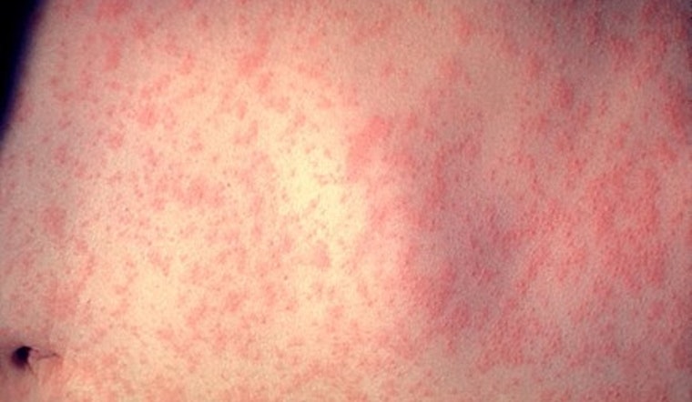 Measles Resurgence Alarms Health Officials in Maricopa County and Philadelphia