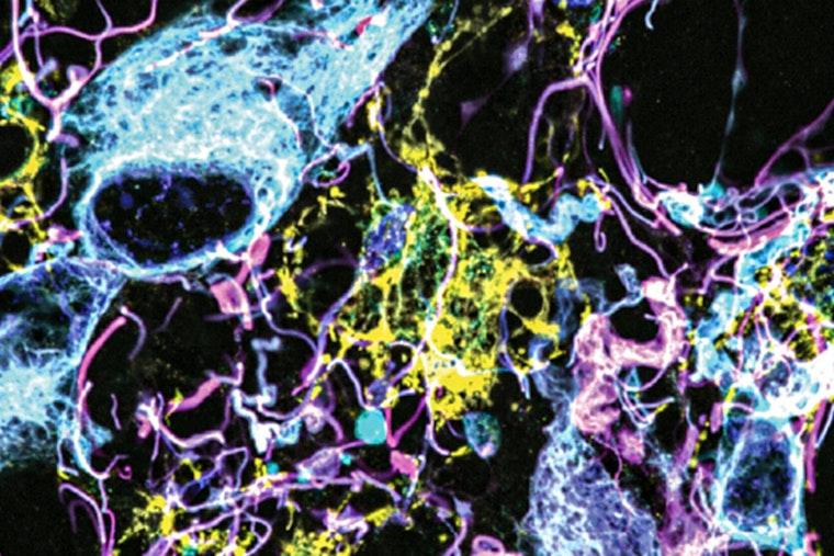MIT and Brigham Researchers Unveil Breakthrough Brain Tumor Nanoimaging, Poised to Transform Diagnosis and Treatment