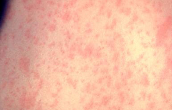 Bay Area Health Officials Issue Measles Alert, Urge Vaccinations Amid Rising Cases Nationwide