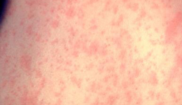 Bay Area Health Officials Issue Measles Alert, Urge Vaccinations Amid Rising Cases Nationwide