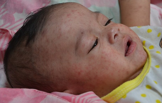 Georgia and Tennessee Grapple with Surge in Measles Cases, Herd Immunity at Risk
