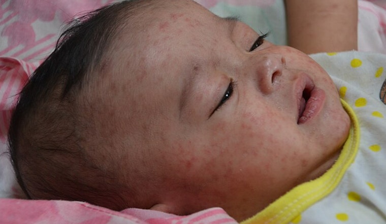 Georgia and Tennessee Grapple with Surge in Measles Cases, Herd Immunity at Risk