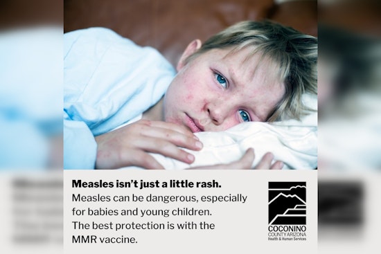 Measles Case Confirmed in Coconino County, Flagstaff on Alert for Potential Exposures at Five Locations