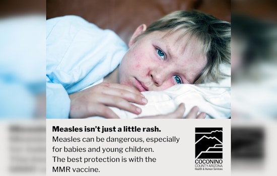 Measles Case Confirmed in Coconino County, Flagstaff on Alert for Potential Exposures at Five Locations