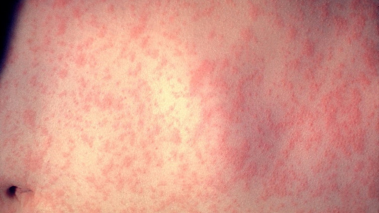 UPDATE: Michigan Faces Rise in Measles Cases, Health Officials Advocate for Vaccination Amid Travel Concerns