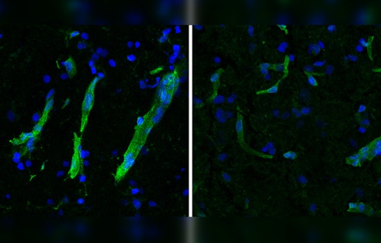 MIT and Mayo Clinic Study Reveals Potential Unified Treatment Path for ALS and FTLD