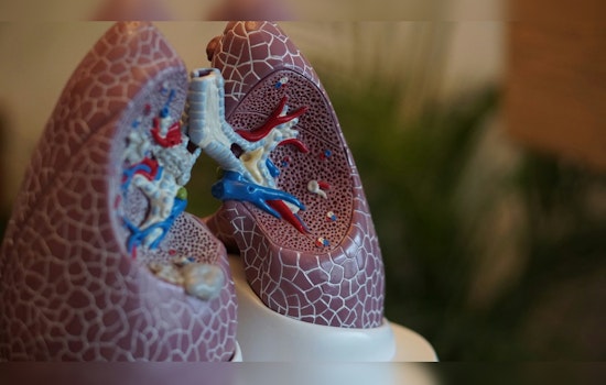 University of Minnesota Unveils Clues to Lung Scourge, Eyes Hope in ARDS Battle