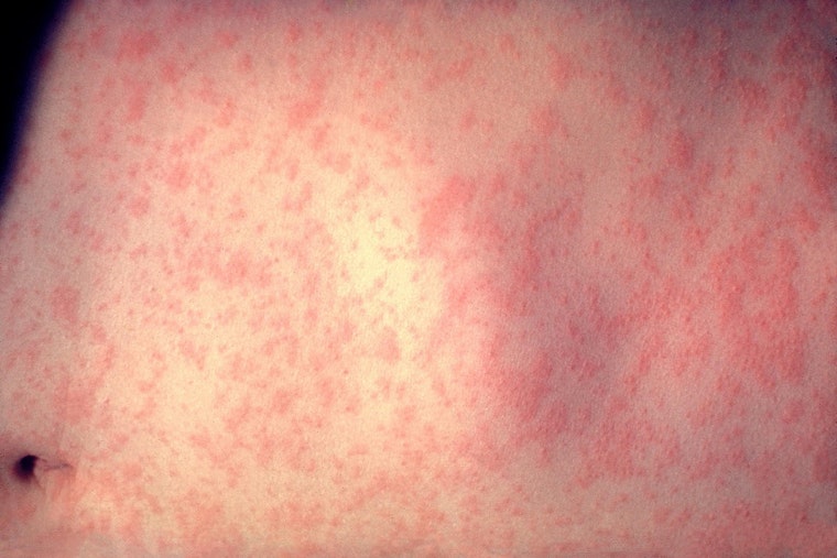 UPDATE: Second Measles Case Confirmed in Michigan's Wayne County Amid Public Health Alert