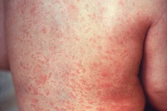 Los Angeles on Alert as Traveler Sparks Measles Concerns, Health Officials Urge Vigilance at Multiple Exposure Sites