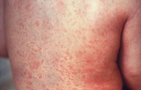 Los Angeles on Alert as Traveler Sparks Measles Concerns, Health Officials Urge Vigilance at Multiple Exposure Sites