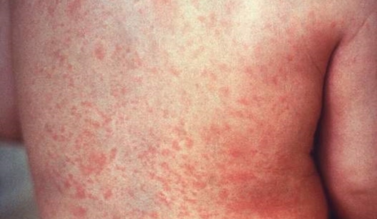 Los Angeles on Alert as Traveler Sparks Measles Concerns, Health Officials Urge Vigilance at Multiple Exposure Sites