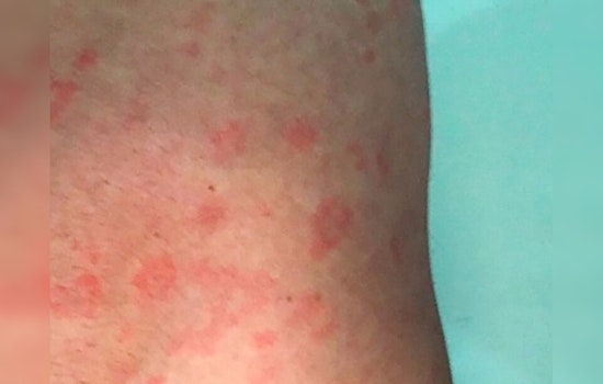 Surge in Syphilis Cases Puts Austin Health Officials on High Alert Amid STI Uptick
