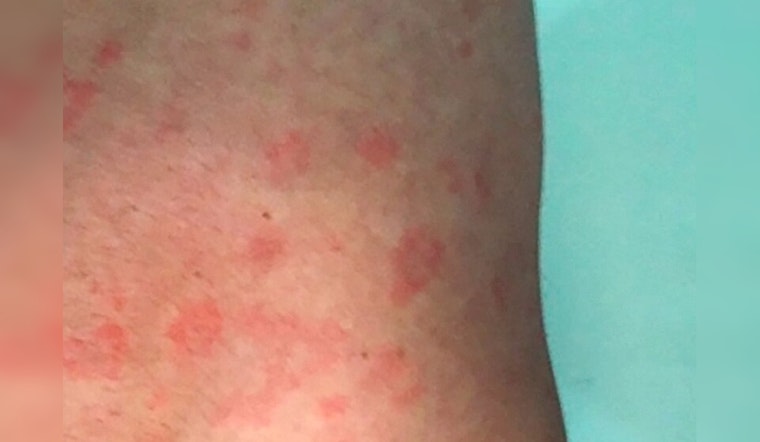 Surge in Syphilis Cases Puts Austin Health Officials on High Alert Amid STI Uptick