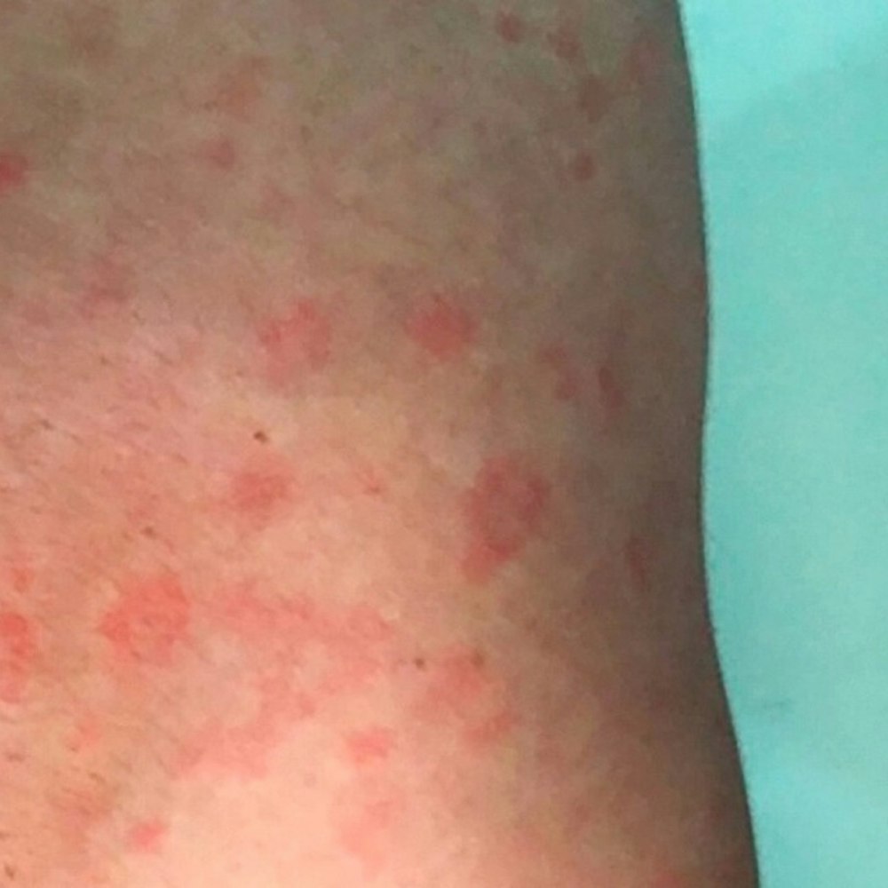 Surge in Syphilis Cases Puts Austin Health Officials on High Alert Amid STI Uptick