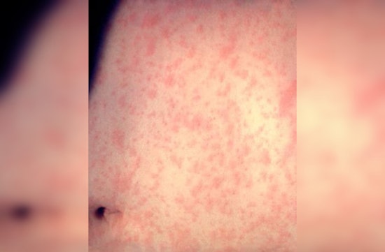 Chicago and CDC Quash Measles Outbreak with Rapid Response and Vaccine Drive