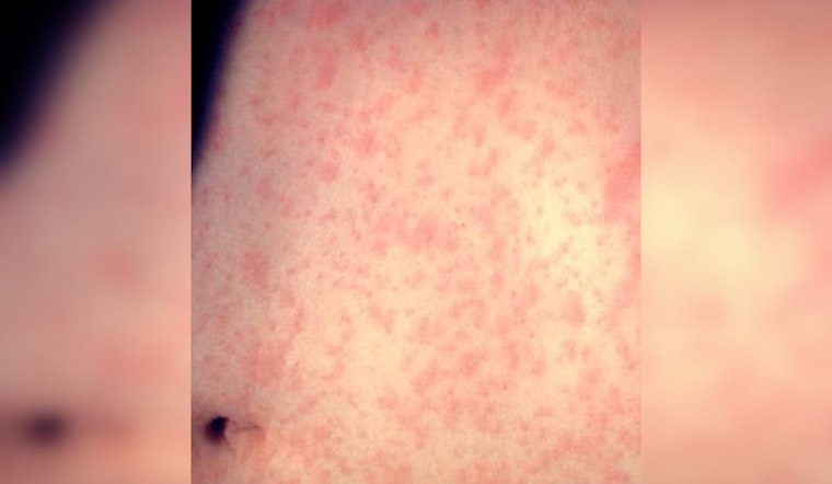 Chicago and CDC Quash Measles Outbreak with Rapid Response and Vaccine Drive