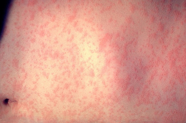 Illinois Health Officials Declare Northeast Measles Outbreak Over, Emphasize Importance of Vaccination