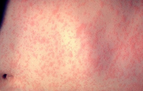 Illinois Health Officials Declare Northeast Measles Outbreak Over, Emphasize Importance of Vaccination