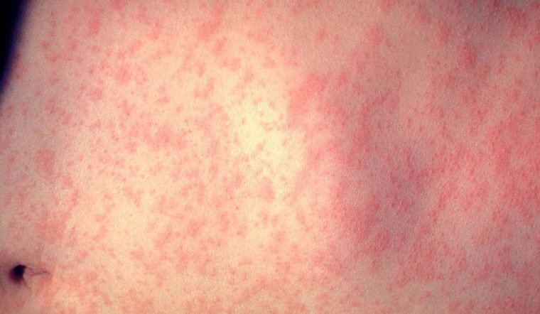 Illinois Health Officials Declare Northeast Measles Outbreak Over, Emphasize Importance of Vaccination