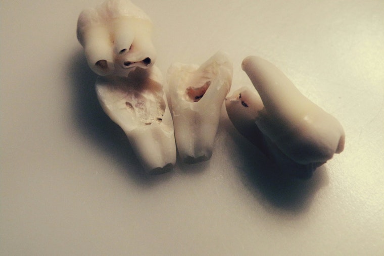 University of Minnesota Expert Dr. James Swift Demystifies Wisdom Teeth Concerns and Removal Process