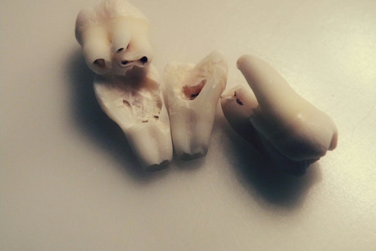 University of Minnesota Expert Dr. James Swift Demystifies Wisdom Teeth Concerns and Removal Process