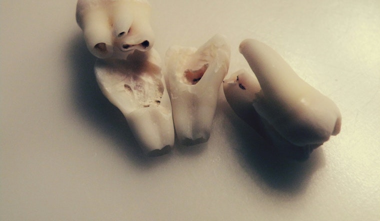 University of Minnesota Expert Dr. James Swift Demystifies Wisdom Teeth Concerns and Removal Process