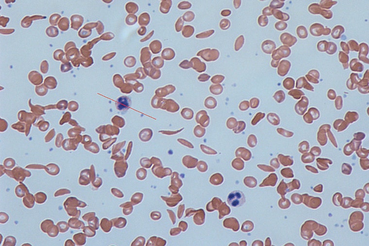 Illinois Advisory Council Tackles Medicaid Reform to Improve Access to Costly Sickle Cell Treatments