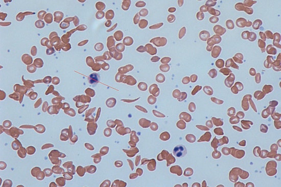 Illinois Advisory Council Tackles Medicaid Reform to Improve Access to Costly Sickle Cell Treatments