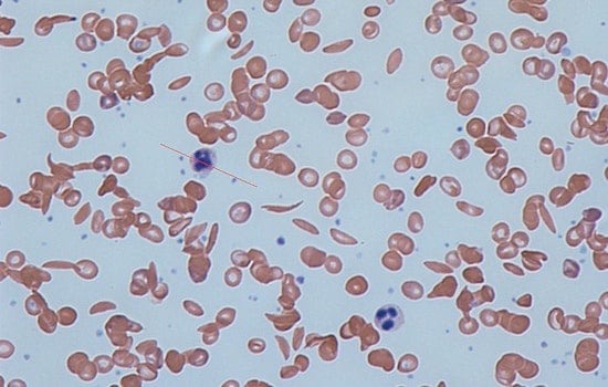 Illinois Advisory Council Tackles Medicaid Reform to Improve Access to Costly Sickle Cell Treatments